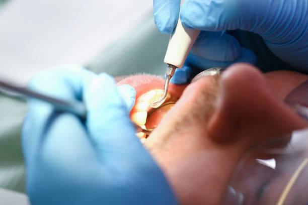 Tooth Infection Emergency Dentist in LA